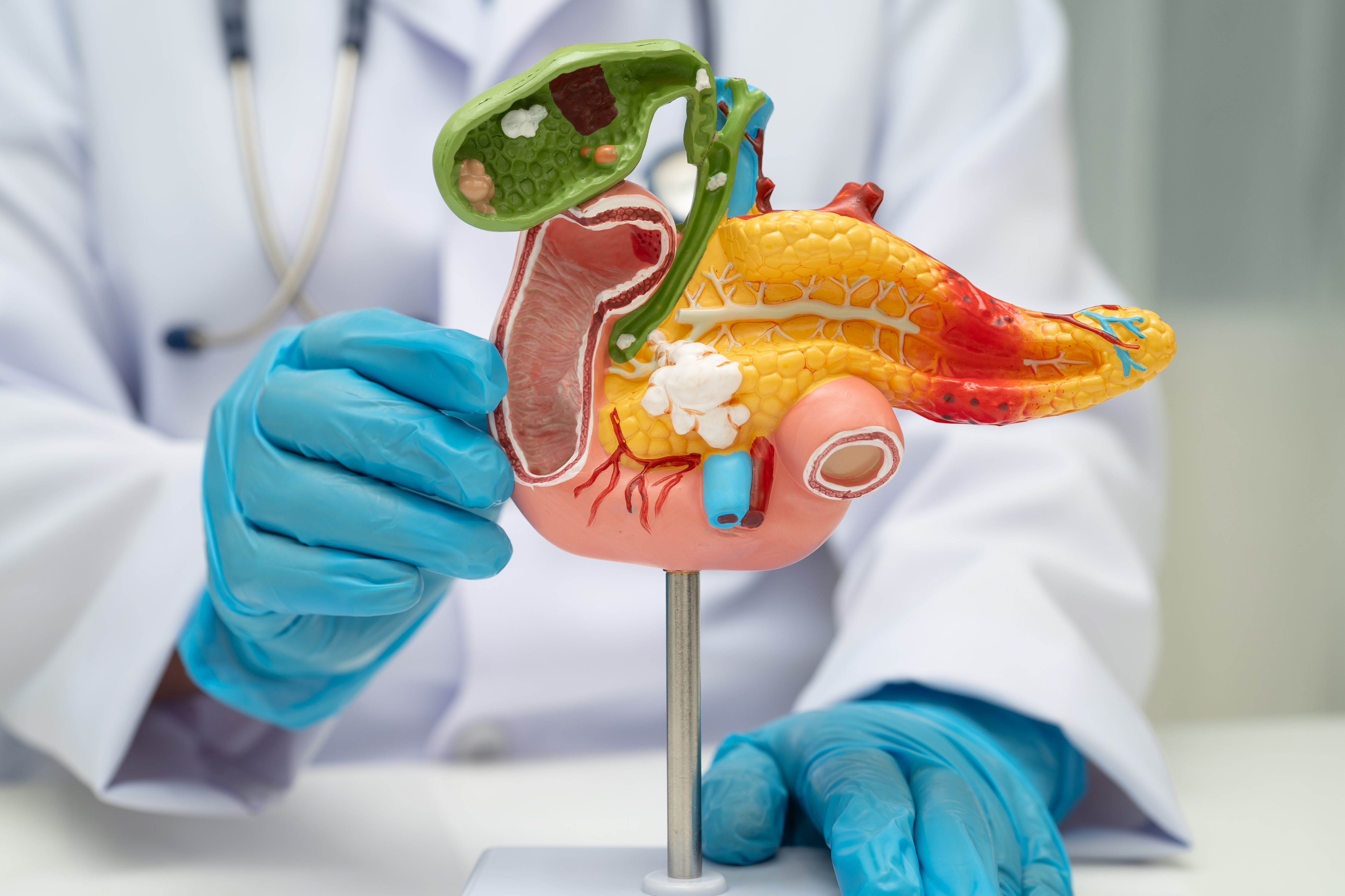 A Rare Cause of Life-Threatening Rectal Bleeding in Acute Pancreatitis